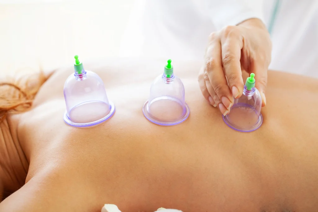 Woman getting cupping treatment