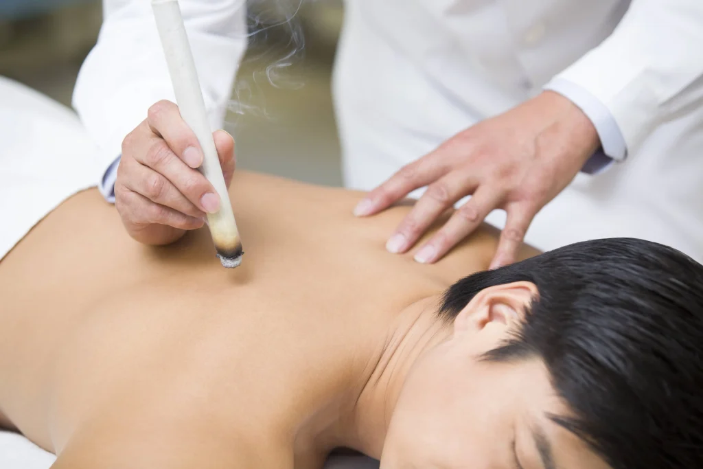 Patient receiving Chinese medicine moxibustion